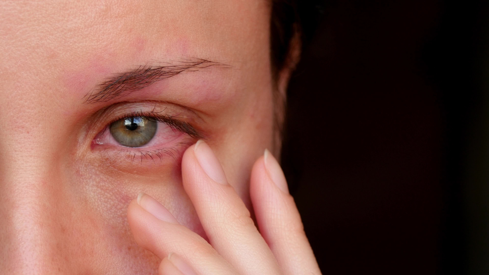 Allergie Augen