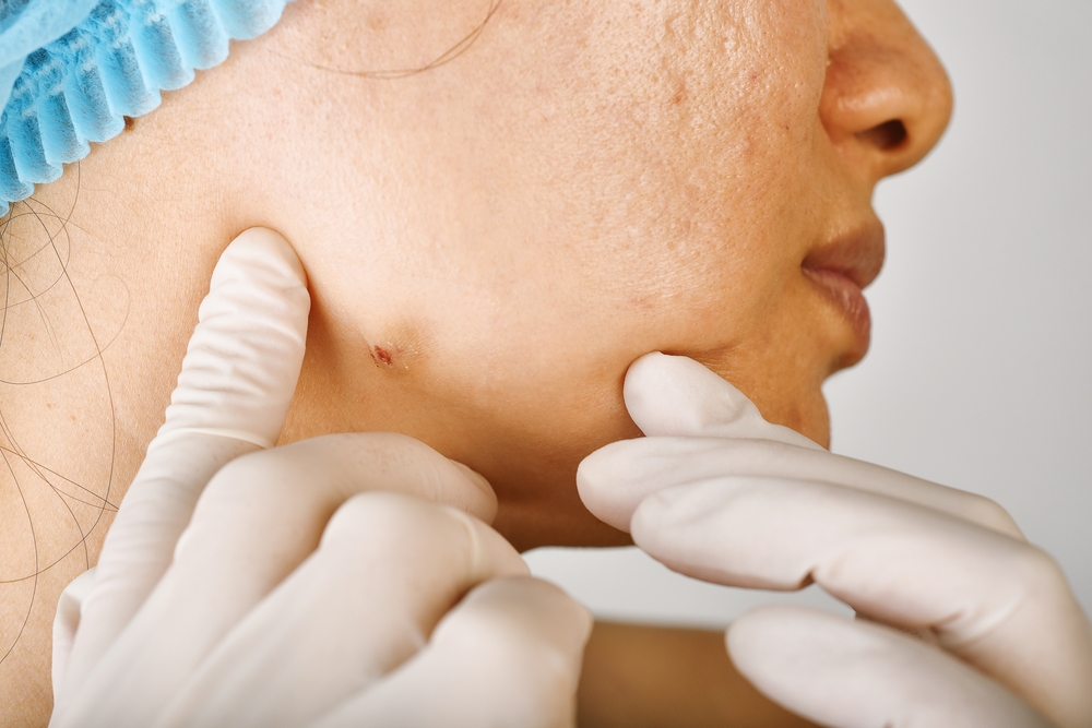 Dermatologe Pickel